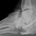 charcots foot