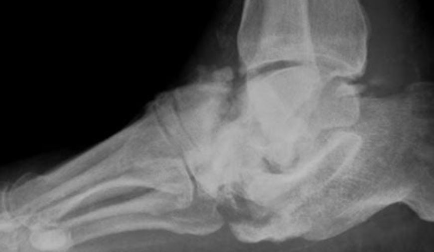 charcots foot