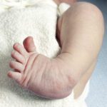 Clubfoot