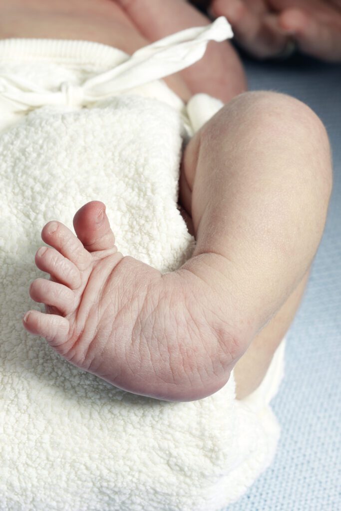 Clubfoot