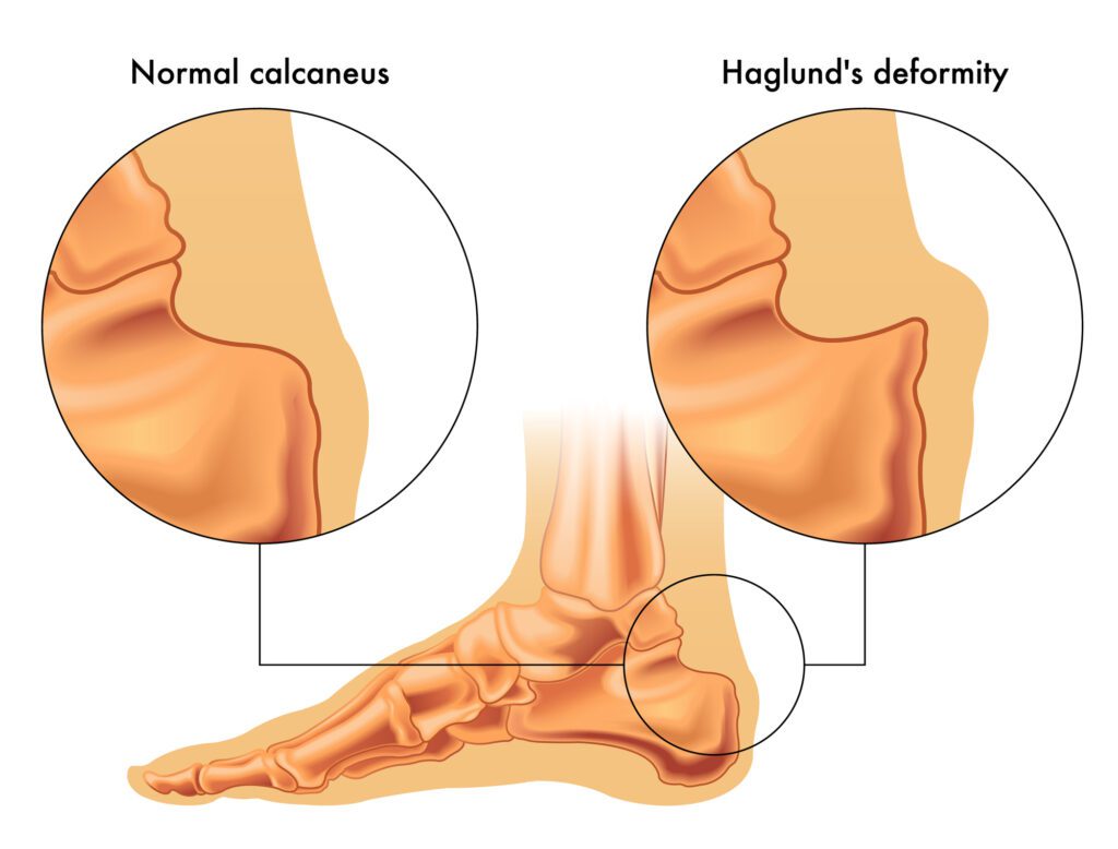 haglunds deformity