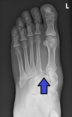 L is for LisFranc Fracture