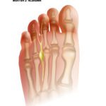 mortons neuroma