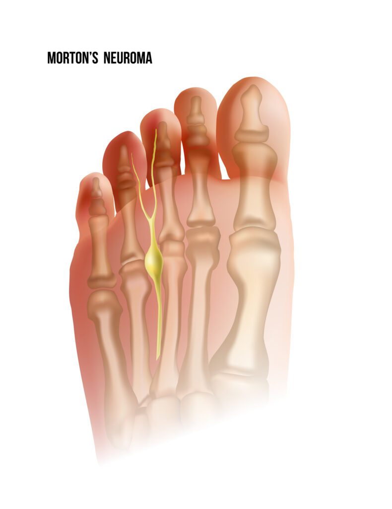 mortons neuroma