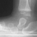congenital vertical talus