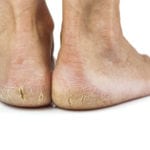 Cracked heels