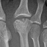 freiberg's disease