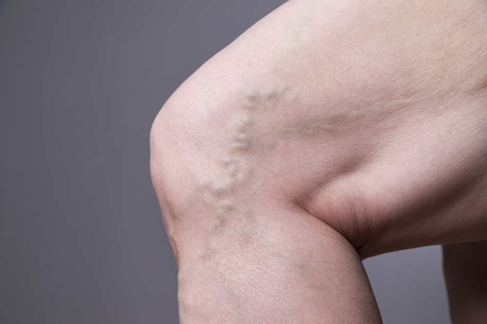 V is for Varicose Veins